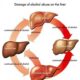 Alcoholic Liver Problems —Causes, Symptoms, Stages & Treatment
