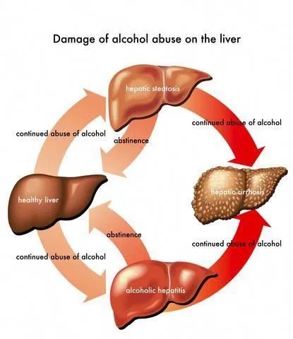 Alcoholic liver