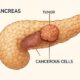 Pancreatic Cancer: Symptoms, Causes, Stages & Treatment