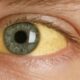 Yellow Eyes: What They Mean, Causes & Treatment