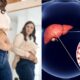 Liver Health and Weight Loss: How Much Weight Loss Can Help?