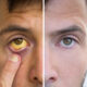 Is Jaundice Contagious? What You Need to Know