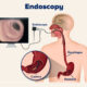 Benefits of Endoscopy: A Small Step Today for a Healthier Tomorrow