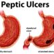 Stomach Ulcers: Causes, Symptoms, and Treatment Options